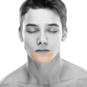 Men's Extended Chin Laser Hair Removal in NYC